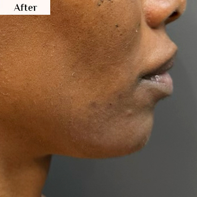 jawline sculpting after